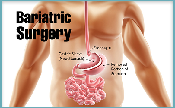 Bariatric-Surgery