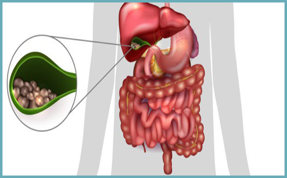 gall-stones