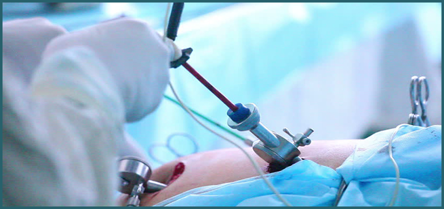 laparoscopic-surgery