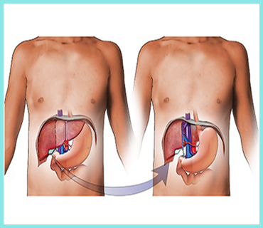 Liver Transplantation